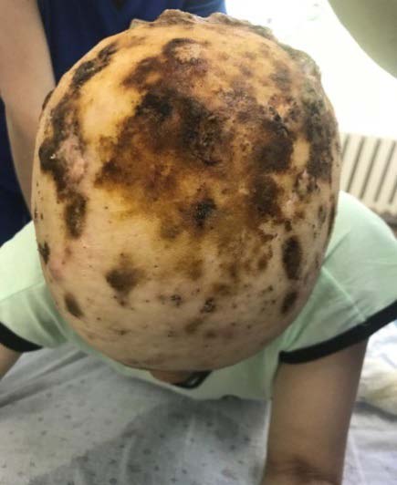 Fig. 2: The scalp at admission. Fig. 3: Onychomycosis of the upper extremities.