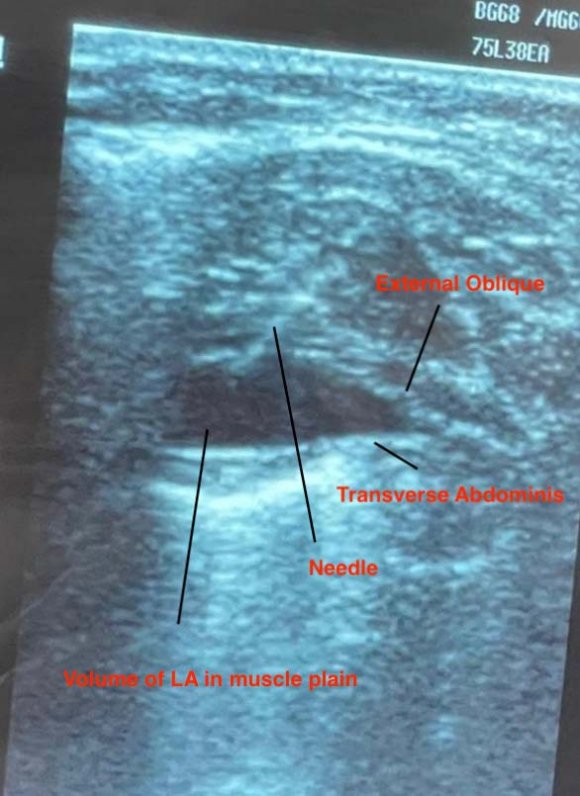 Figure 4: Piecemeal removal of left intrathoracic mass