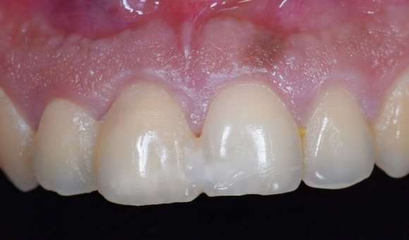 Intra-Oral Pre-Operative 2. Pre-Operative CBCT viii. The membrane was then tucked through the vestibular access incision (Figure No: 8), till it reaches 1 mm apical to the socket orifice, and stabilized using two membrane tacs (AutoTac System Kit, Biohorizons Implant Systems, Birmingham, Alabama Inc, USA) to the sound apical bone. ix. The gap between the implant and the shield/the labial plate was then filled with particulate bone graft [autogenous bone chips harvested form local surgical site mixed with inorganic bovine bone mineral matrix (MinerOssX, Biohorizons, Birmingham, Al, USA)] (Figure No: 9). x. Finally, the vestibular incision was secured with 6/0 nylon sutures (Stoma, Storz am Mark GmbH, Emmingen-Liptingen Germany) (Figure No 10). xi. A temporary Peek abutment (Figure No: 11) Inc, USA) was trimmed to the socket orifice level and the gap was filled with composite resin (Filtek? Supreme Ultra Flowable Restorative, 3M Corporate Headquarters, MN, USA) to create a sealed chamber that protected the bone graft. xii. Post-operative follow-up advised 10 days after surgery (Figure No: 12). xiii. Final crowns (full anatomical zirconia, bruxzir, Glidewell, CA, USA) were cemented 2 months postimplant placement (Figure No: 13). xiv. Patient recalled again at 6 months for follow-up visit (Figure No: 14). 7. Implant Placement Through 3D Printed Surgical Guide 8. Insertion of Cortical Membrane from the Vestibular Access Incision Up Till Socket Orifice and Stabilized with Auto-Tacs 9. Placement of Particulate Bone Graft Filling the Bone Defect 13. Final Prosthesis at 2 Months 14. Follow-Up at 6 Months Post-Operative Phase Antibiotics like Ciprodiazole (Combination of Ciprofloxacin 500mg and Metronidazole 500mg) and Analgesics (any NSAID (non-steroidal anti-inflammatory drug) are prescribed for a 5 day course along with rinsing with Chlorhexidine mouthwash 0.12% twice a day for 1 week. Advantages of VST 1) Used in infected freshly extracted sockets (thin, lost and infected) 2) Treat multiple teeth at a time 3) Single surgical entry 4) Minimal or no facial gingival recession 5) Pre-prosthetic profiling not required 6) Minimal post-operative soft tissue trauma 7) Treatment time reduced to 8 weeks