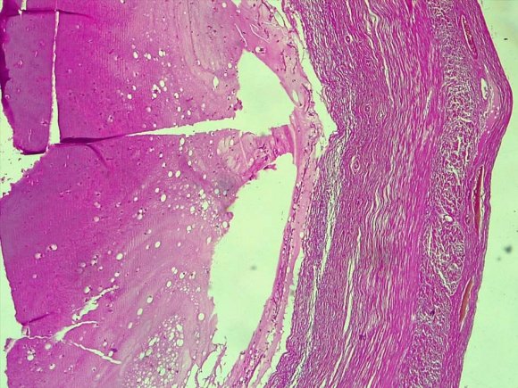 Figure 2: HE x 250: histological aspect of an appendicular mucocele showing a dilated lumen with abundant mucoid substance infiltrating the smooth muscle layers and serosa.