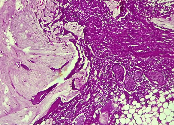 Figure 3: HE x 250: histological aspect of an appendicular mucocele showing in the periphery of the wall, in the peritoneum, mucus patches without tumor masses and malignant tumor cells.
