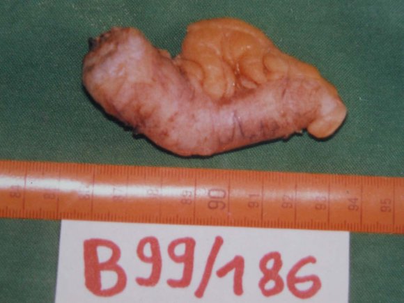 Figure 4: Appendectomy specimen for appendiceal mucocele: Note the swollen appearance of the appendix especially marked in its proximal half.