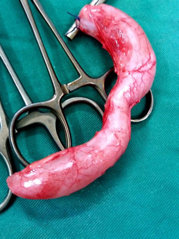 Figure 5: Appendectomy specimen. Note the uniformly dilated appearance of the appendix.