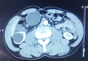 Figure 6: CT scan section showing the cystic mass with wall enhancement (thin arrow). Note the cyst on the lower pole of the right kidney (thick arrow).