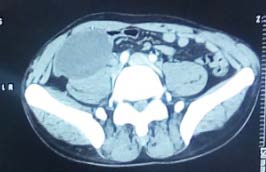 Figure 7: Scannographic section showing the cystic mass coming into contact with the psoas in the right iliac fossa.