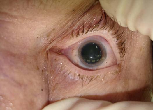 Reaction upon chemical excitation with mydriatic per hours PM Chemical excitation with mydriatic Adrenalin HCl: -certain positive reaction -post mortem period up to 12 hours uncertain reaction -post mortem period of 12 to 25 hours Reaction upon chemical excitation with miotic per hours PM Chemical excitation with miotic Carbachol: -certain positive reaction -post mortem period of 2 to 11 hours uncertain reaction -post mortem period of 12 to 25 hours c) Algor Mortis Chart 5 : Discrepancy of probable time of death obtained by the Henssge Nomogram from the actual time of death in hours discrepancy within limits from -2 to +2,5 hours.