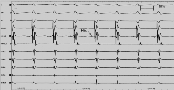 Figure 1 : Intracardial electrocardiogram of the AVNRT (slow/fast) ????? 1. ????????? ????? ????????????????? ?? ????? ( ?????/????)
