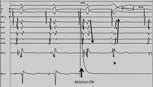 Figure 4 : Intracardial electrocardiogram of the ablation in the higher parts in the triangle of Koch with shifting of the earliest retrograde atrial activation site from the superoseptal to the inferoseptal area (*nodal extra beat) without accelerated junctional rhythm.