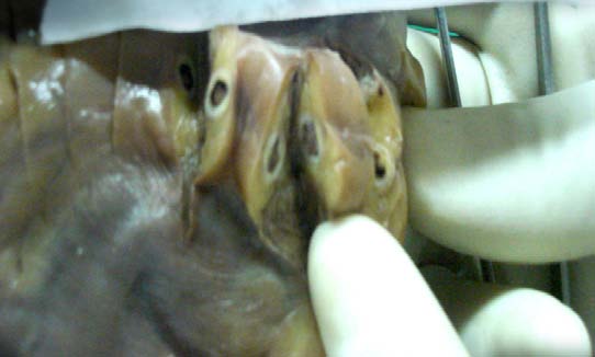 Figure 1 : Intraoperative complications for TURP in GHRDS January 2012-June 2013