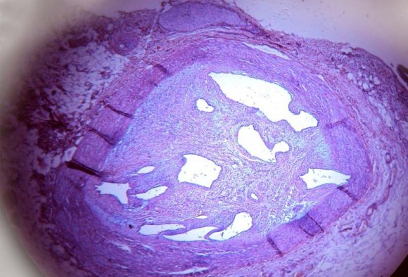 Fig. 1: Heart along with coronary arteries and aorta upto its bifurcation