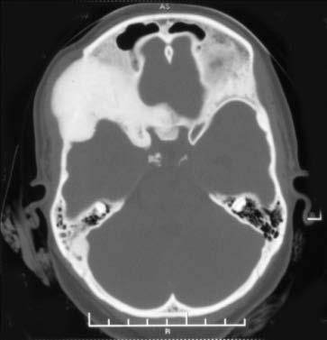 Fig." 11 shows resultant image after CT and MR volume matching using ridgeness correlation.