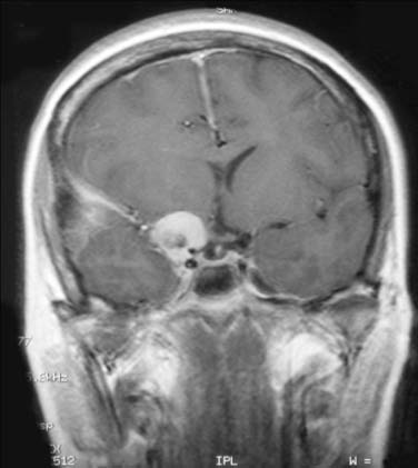 Figure 11 : CT and MRI matching using ridgeness correlation