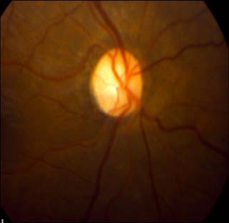 Figure 1.a : Atrophy of the right optic disc