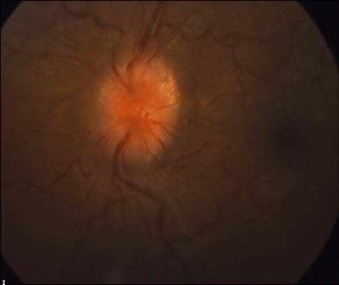 Figure 2 : Humphrey perimeter of the left eye disclosed an superior nerve fiber bundle defect CT scan of the brain showed hyperostosis in right sphenoidal and right Occipitoparietal bone (fig.3). MRI/MRV(fig.4) showed right sphenoidal wing strongly enhanced mass that consistent with the diagnosis of meningiomatosis. It extended from the right orbital apex through the optic canal and into the intracranial space. MRV study showed thrombosis of the posterior third of the superior sagittal sinus and the right sigmoidal sinus (fig.5) Diagnostic Angiogram showed tow tumor blushes highly suggestive of meningiomas (fig.6)