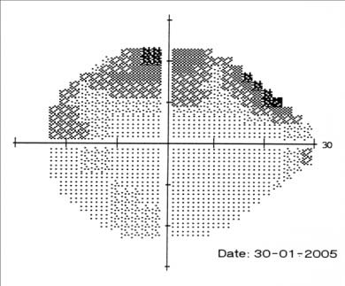 Figure 5 : MRVthrombosis of the posterior third of the SSS