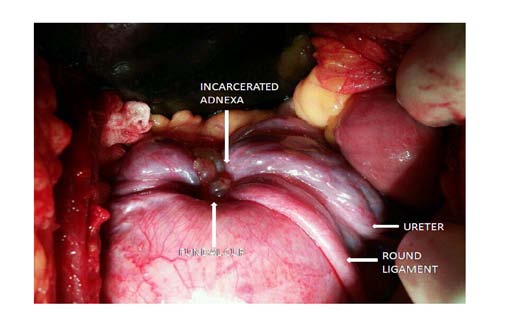 Figure 3 : Hysterectomy specimen showing a large prolapsed submucous fundal fibroid with inverted fundal cup and adnexal structures incarcerated within it.The endometrial lining is turned inside out due to the inversion.