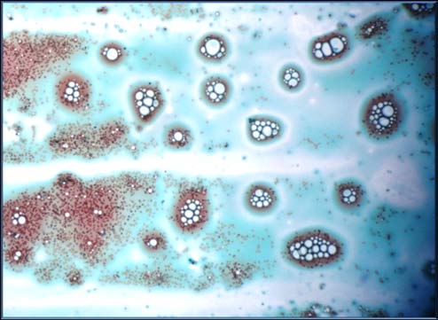Figure 1 : Gram staining of Pseudomonas aeruginosa showing Gram negative bacillus rods.