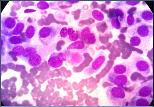 Figure 2 : Hurthle cell changes in Hashimoto thyroiditis