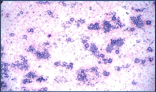 Figure 3 : Numerous macrophages only: Nondiagnostic category