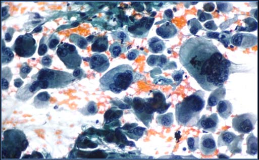 Figure 4 : Medullary carcinoma of thyroid with amyloid like material