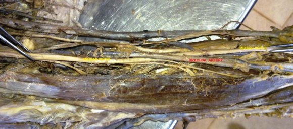 months, six and twelve months postop-eratively and every year thereafter for 3 successive years. Diagram (1). technique we followed them clinically, sonographicaly and, laboratory; CBC, (Ca++), albumin, iron, zinc, Vitamin B12 and Prothrombin Concentration (PC) were Patients showed significant EWL Figure (1), in addition no significant decrease in minerals, vitamins or proteins were reported Table (1, 3). Patients did not need vitamins or albumin supplementation, whatever the clinical outcome related -GI motility disorders did not difference than other bariatric procedures Figure (3). Patients appeared in better contour 1 year after the procedure Figure (4 & 5).