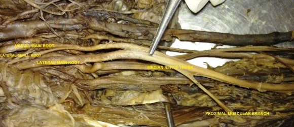 Fig.1 : Left upper limb specimen showing absence of Musculocutaneous nerve and 3 roots of Median nerve