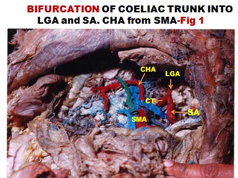 , shows CT with quadrifurcation i.e. LGA, SA, CHA and SMA all of them arising from Coeliacomesentric trunk. The patterns of the coeliac trunk were observed to vary from classical trifurcation,to abnormal trifurcation, bifurcation, quadrifurcation, pentafurcation and even hexafurcation of the coeliac trunk. The present study in 4 male cadavers includes variation in the CT branches. The CT showed to abnormal trifurcation, bifurcation, quadrifurcation and pentafurcation. (Fig-1,2,3&4) Adachi & Michel et al have classified CT intosix types 8&9.