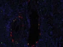 Fig. 1 : Representative images of epidermis, hair follicle, and hair bulb samples from a patien (Part 1, number 23). Panel A: Samples collected at Baseline, 24 hours and 48 hours after chemotherapy administration. Panel B: Recolored image for manual enumeration of an epidermis sample at 48 hours. A: CDC2 + pCDC2 (yellow); B: CDC2 only (red); C: negative cells (blue); D: melanin (green). For this sample, 74% of the CDC2 positive cells expressed pCDC2 (parameter 4 shown).