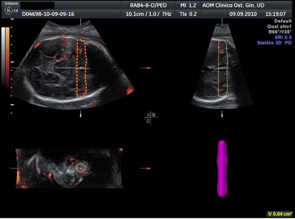 Fig 1 : CSP: cavum septi pellucidi. 1: "Frontal zone", 2: "Temporal zone"