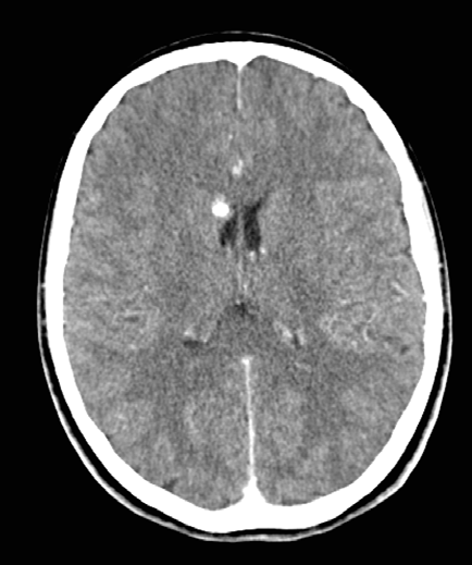 Figure2depicts the right focal mesiobasal seizure onset with its spread and generalization presumably through the right fornix and with preferential right cortical involvement. The involvement of the contaralateral mesiobasal structures developed later. This type of bitemporal epilepsy with secondary generalization primarily through the side of initial seizure onset is an example of when surgery might be limited to unilateral amygdala-hippocampotomy and fornicotomy, despite the involvement of contralateral mesiobasal structures.Figure3depicts the bilateral spread of a right mesiobasal epileptic seizure with bilateral cingular and cortical involvement and subsequent generalization in a patient with depression and anxiety. The contralateral amygdala-hippocampal involvement develops after cortical generalization indicating a presumed secondary fronto-temporal seizure spread into the left amygdala-Volume XIV Issue I Version I