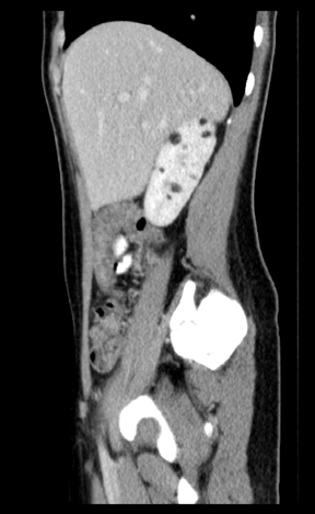 bilateral amygdalatomies with unilateral hippocampotomies, 21 bilateral amygdalatomies and unilateral hippocam-potomies in combination with contralateral anterior hippocampotomies. The other extratemporal lesions combined with the temporal lobe mesiobasal targets were performed based on the meticulous assessment of all evaluation data.Volume XIV Issue I Version I© 2014 Global Journals Inc. (US) Types of surgeries performed for Group B patients and their outcomes with respect to seizures (follow-up 1-5 years). Numbers in parentheses represent the Group A patients received reoperation