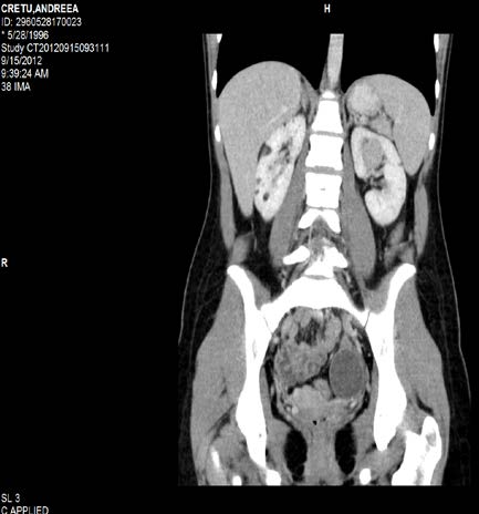 performed bilateral one-stage stereotactic interventions on mesiobasal temporal Volume XIV Issue I Version I Year ( structures or stereotactic operation on one temporal lobe and an open operation on the contralateral temporal lobe in patients with bitemporal epilepsy.
