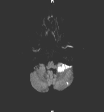 Figure 2 : Cerebral MRA Showed Moderate to Sever Mid-Portion of Basilar Artery Stenosis Along with Left Side Poor Visualization of AICA Distribution (Black Arrow).