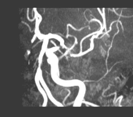 Figure 3 : Auditory Brain Stem Evoker Potential (AEP) Showed No Elicitation of Left Side First to Fourth Wave-Forms Under Normal and Enhanced Stimuli. Right Side AEP was Normal.