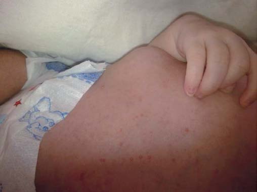 Figure 1 A : Posteroanterior chest radiograph shows left upper lobe consolidation and a cavitary opacity in the left