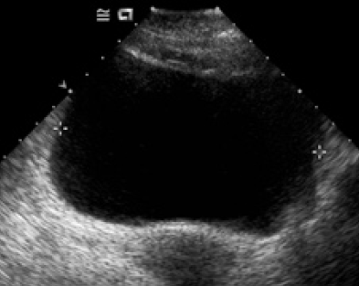 Figure 2 : Retrograde and voiding urethro-cystography was normal