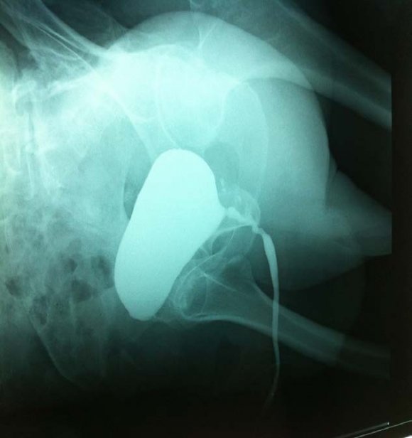 Figure 3 : Urodynamic testing demonstrated the unabilty to generate any voiding contraction III.