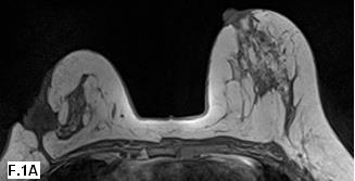 Fig. 2 : Neoplastic recurrence. 53 year-old female submitted to left quadrantectomy 3 years ago for invasive ductal carcinoma. (A) Axial T1 GRE (VIBE) & (B) Axial SITR demonstrate a left breast ill d efined lesion at the surgical scar. (C) DWI with b= 800 shows a hyperintense mass (arrow). (D) ADC map displays hypointense lesion (green arrow) with ADC value in the mass is 1.16 x 10 -3 mm2/s. (E) Post-contrast study shows marked enhancing mass with minut e satellite nodule. (F) dynamic curve shows washout curve