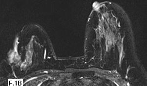 Fig. 4 : Post-operative seroma. 36 year-old female submitted to left quadrantectomy 10 months ago for ductal carcinoma. (A) Axial T2 FS & (B) post -contrast