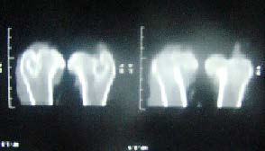 Figures 3 : (A.B.C,D) CT images(A,B) shows CT scan Axial cuts of proximal ends of both femurs of 8 years German Shepherd canine, the left femur is normal but the right is affected. (C, D) shows: (3D) three Dimensional CT image of proximal ends of both femurs