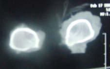 sign as the radiographs are taken non-weightbearing. Individual soft tissue structures are not visualised as easily as the bony structures unless they are bordered by fat . Indirect information on articular soft tissues structures can be present in case of calcification within these structures, mostly a sign of degeneration Volume XIV Issue II Version I