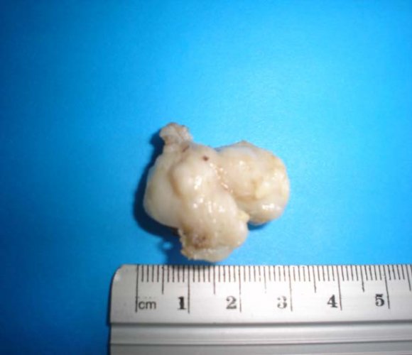 Figure 3 : Pelvic CAT ? Tumor markers: normal. ? Liquid based cervical cytology: negative for intraepithelial lesion or malignancy. ? Automated large-core biopsy of the mass with a 14gauge needle: diagnosed large cell lymphop-