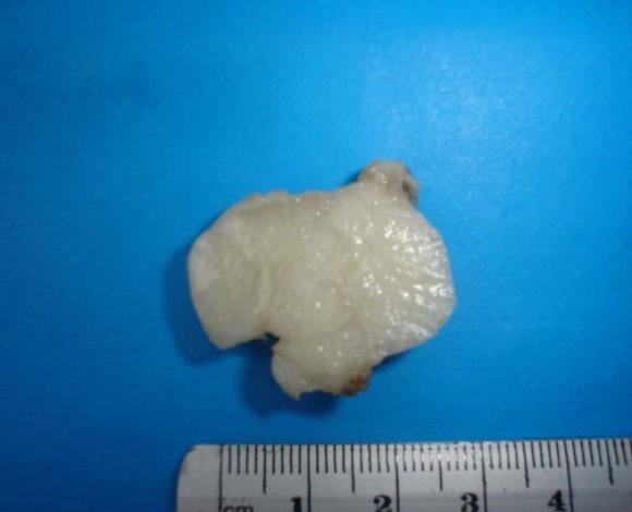 Figure 4 : Histological examination of the tumor: hematoxilin-eosin staining