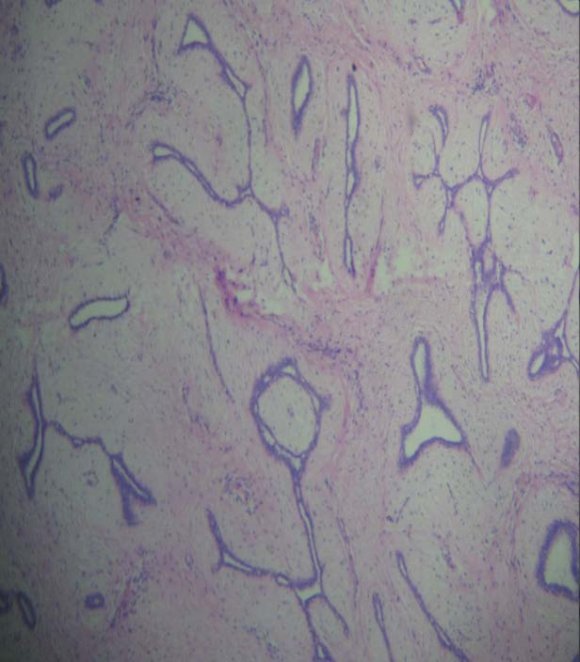 Figure 5 : Immunohistochemistry study: CD20 that identifies the lymphoid phenotype B Given the pathological diagnosis proceeded to perform a bone marrow biopsy to rule out involvement of the same, performing a puncture in the right iliac crest with result: bone cylinder normocellular no relevant morphological lesions without signs of atypical lymphocytosis in the material submitted. After the result of the additional testing and the extension study, was diagnosed with non-Hodgkin lymphoma, diffuse large B cell uterine location. Stage IV, extranodal bulkit mass with right parametrial infiltration, not infiltrated bone marrow, two IPI risk factor (R-IPI 2).