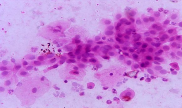 non-keratinizing variety is the commonest variety.VI.