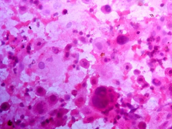 Figure 1 : Photomicrograph of HSIL showing group of hyperchromatic parabasal cells exhibiting nucleomegaly and overlapping nuclei (PAP X 400)