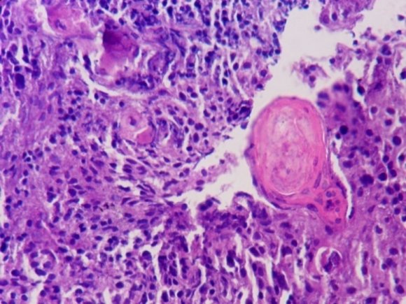 Figure 2 : Photomicrograph of Squamous cell carcinoma showing tumour diathesis, malignant cells with nucleomegaly, hyperchromatism and irregular nuclear margins (PAP X 400)