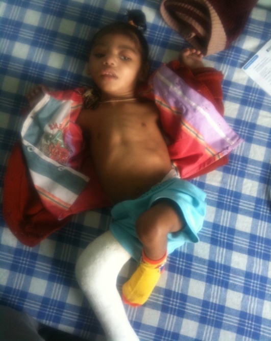 Fig. 3,4 : X-Ray AP & Lateral of knee joint showing Pelkan spur& white line of Frankel(arrows), Trumerfeld zone