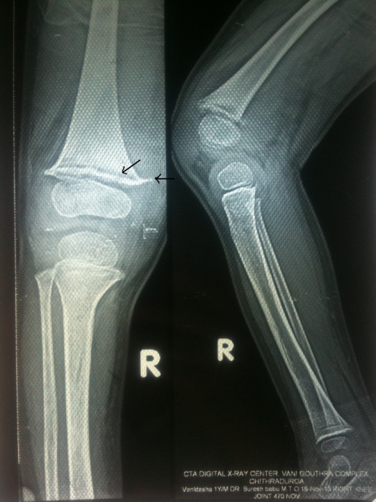 Fig. 4 : X ray of knee joint showing healingScurvy is less common in the pediatric population, but case reports still appear[1][2][3]. A review of the literature by Noble et al. reveals twenty three case reports of scurvy in children with behaviourally restricted diets including children with autism, mental retardation and cerebral palsy[4]. Scurvy is common in children with cerebral palsy as they subsist on predominant milk based diets (due to pseudobulbar palsy and difficulty swallowing solids) and boiled cows milk is a very poor source of vitamin C. deficiencies may be noted in preterm babies who are on prolonged TPN therapy, children with malnutrition and those with acute illnesses. Musculoskeletal manifestations are present in 80% of patients with scurvy and are prominent in pediatric population[3,5]. Musculoskeletal manifestations include sub-periosteal hemorrhages leading to bone pain and musculoskeletal complaints such as limb pain, limping, swelling over long bones, and progressive leg weakness and fractures[6]. Dermatological manifesttations include petechiae, ecchymoses, hyperkeratosis, and perifollicular hemorrhage[3,7]. Oral symptoms include gingival disease characterized by swelling, bleeding gums, and loosening of teeth[3,6,8]. Systemic symptoms of scurvy in children include lassitude and fatigue, failure to gain weight, loss of appetite, and irritability[6]. In addition to these symptoms, deficiency of ascorbic acid may lead to a hypochromic microcytic anemia because of decreased absorption of iron, bleeding, and dietary deficiencies[3,6].The diagnosis of scurvy is based on history of poor dietary intake of vitamin C, classic clinical features and radiological findings and response to treatment with vitamin C.[3, 14]. Weinstein et al.[3] recommend oral doses of 100 to 300 mg of vitamin C daily until body stores are replenished per serum levels. Daily fruit and vegetable intakes should include a good source of