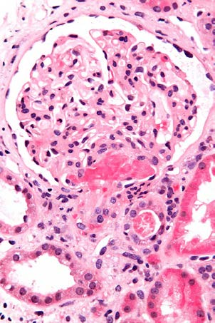 manage. Eculizumab could be appropriate in patients with normal ADAMTS13 activity who have not shown improvement after two weeks of daily plasma exchange. There is still not enough data to guide treatment based upon complement testing. Additional concerns with this approach include the following:Algorithmic Approach to Diagnosis and Treatment of TTP a) Conflict of Interest All authors have no any actual or potential conflict of interest including any financial, personal or other relationships with other people or organizations within three years of beginning the submitted work that could inappropriately influence, or be perceived to influence, our work.